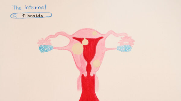 This image is a simple illustrated diagram of the female reproductive system with the search phrase "The Internet: Fibroids" written in the top left. The uterus and surrounding organs are depicted with several yellow-beige circles indicating fibroids in various locations. The ovaries are shown in blue, and the anatomical structures are outlined in pink and red on a plain background, providing an educational overview of fibroids within the uterus.